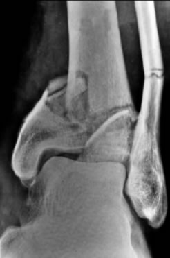 fracture