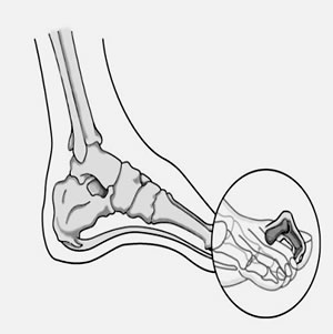 hammertoe